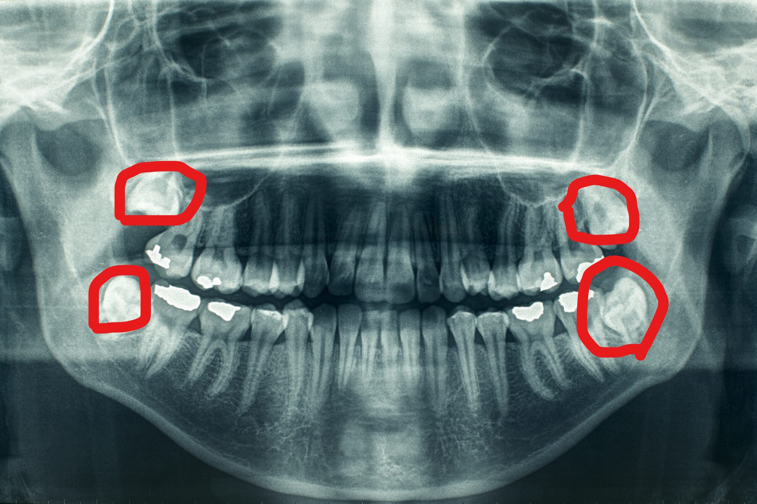 dental extraction