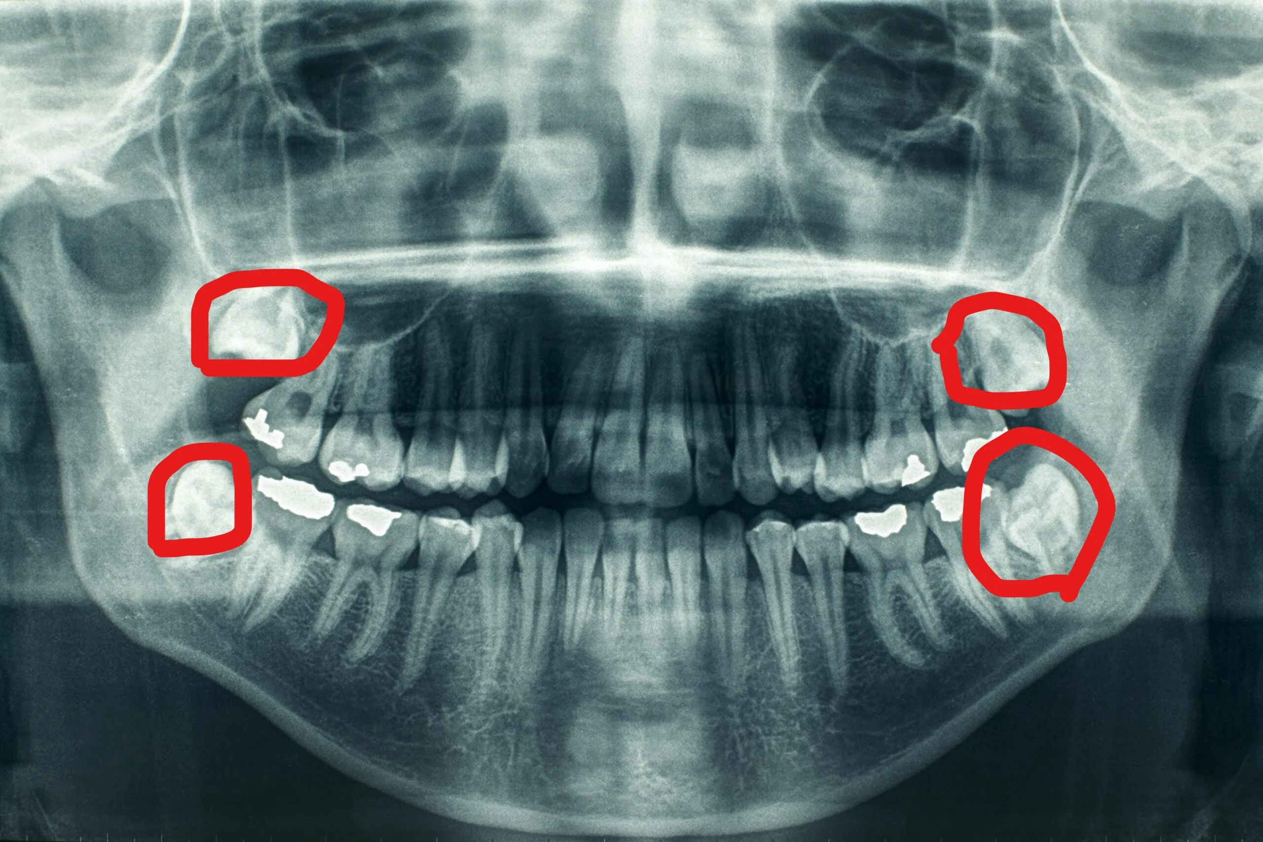 Extracción de Muela de Juicio en Oxnard 15 dental extraction