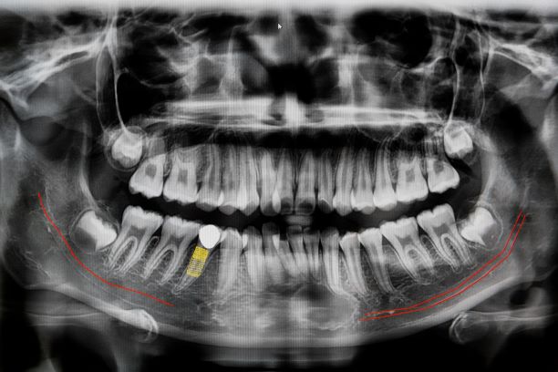 digital x ray of jaw with implant tooth PFB4D6X