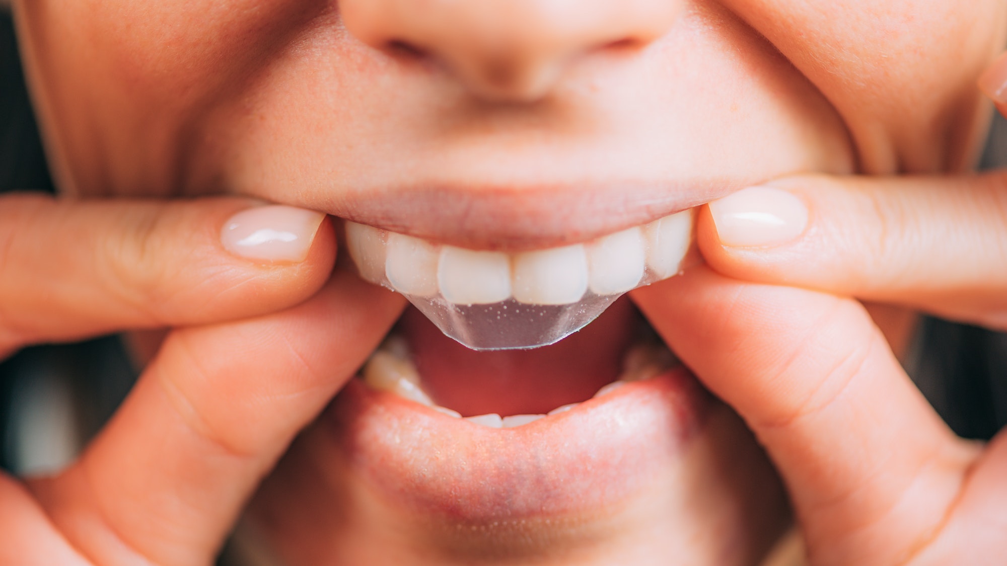 whitestrips or teeth whitening strips