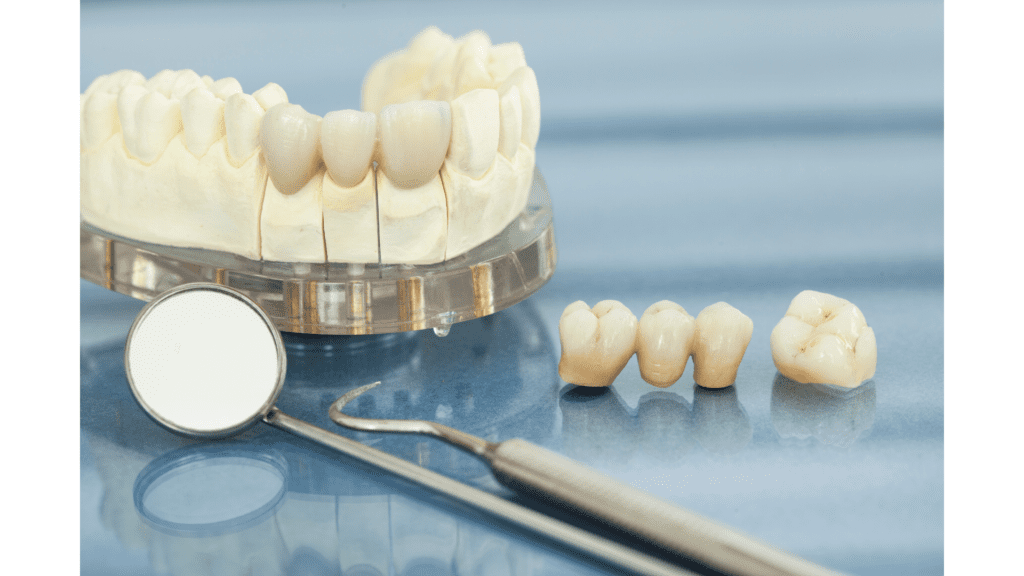 Coronas de Porcelana 10 Porcelain Crowns