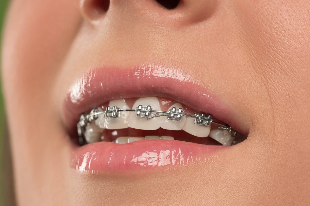 beautiful young woman with teeth braces