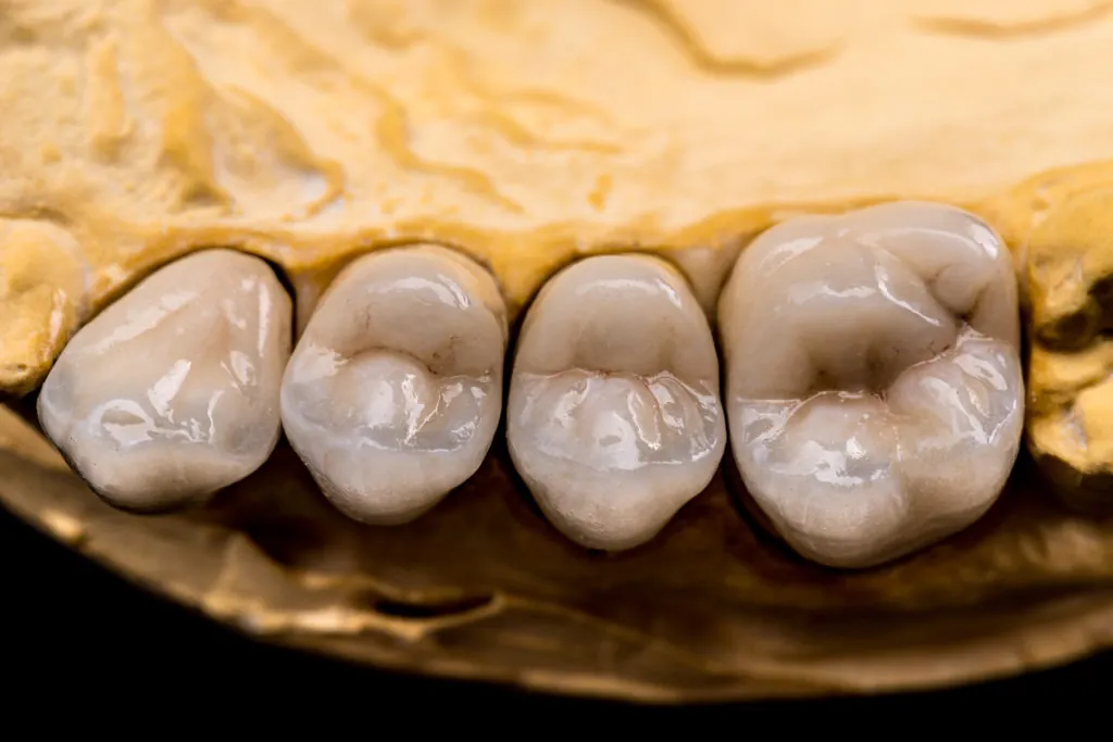 Porcelain Crowns 15 Denture made of ceramics