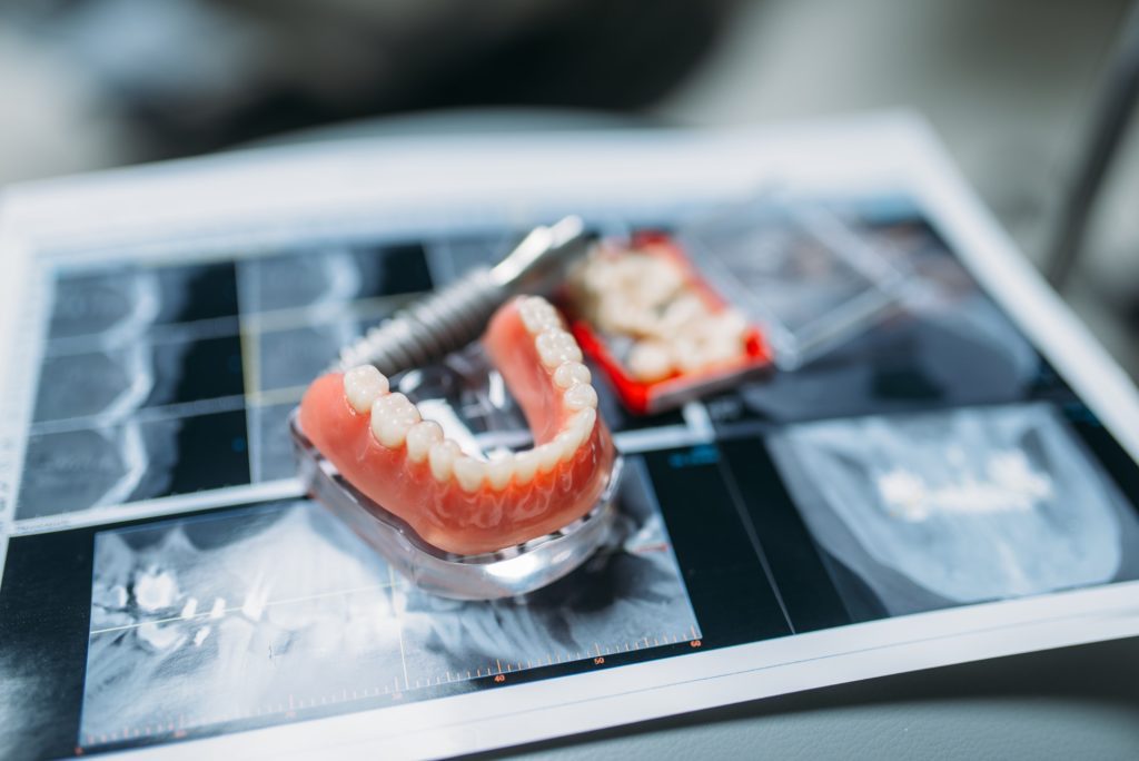 Dentadura postiza 3 dentures and pins on the table dental prostheses