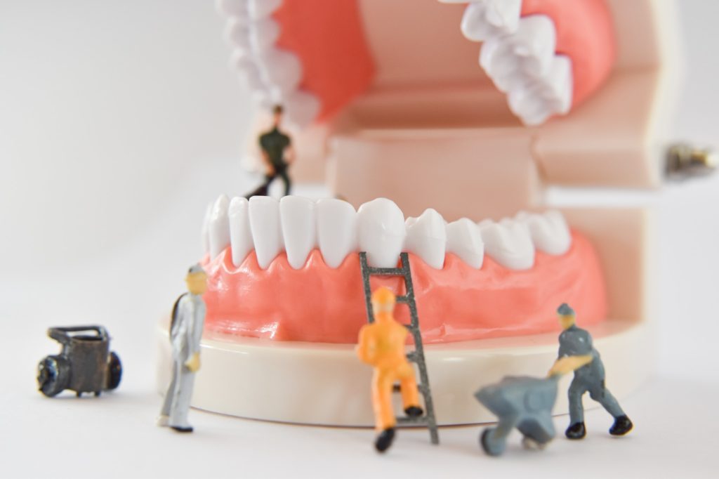 Carillas a Presión 24 miniature people to repair a tooth