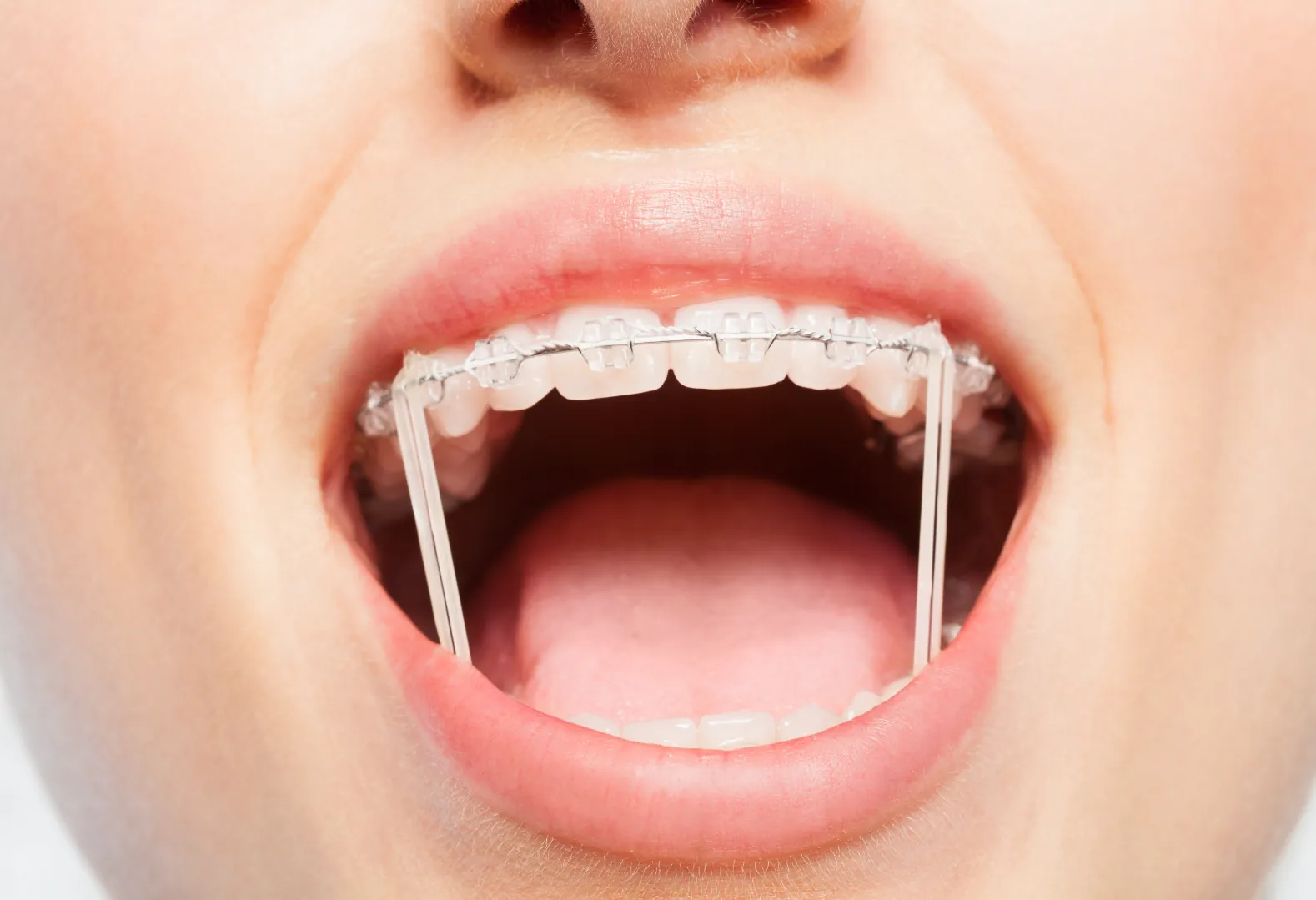 Clear Braces 20 Woman smiling in the mirror