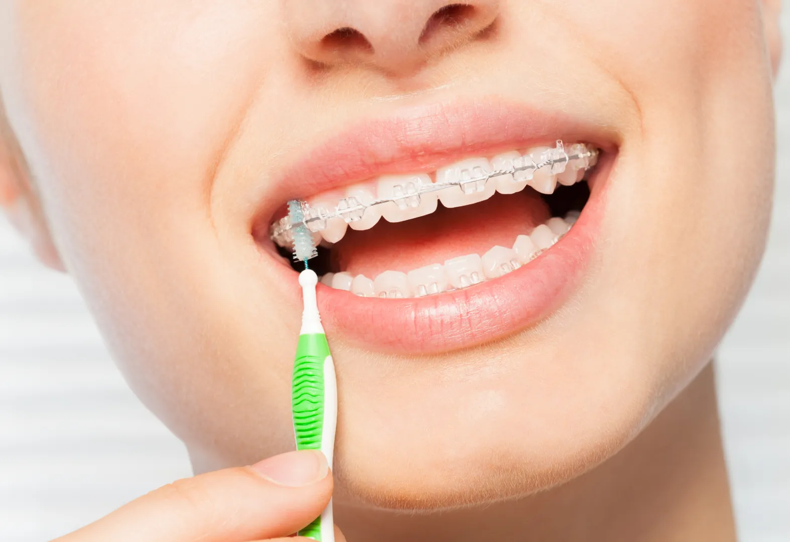 Cosmetic Dental 14 Clear Braces in Oxnard