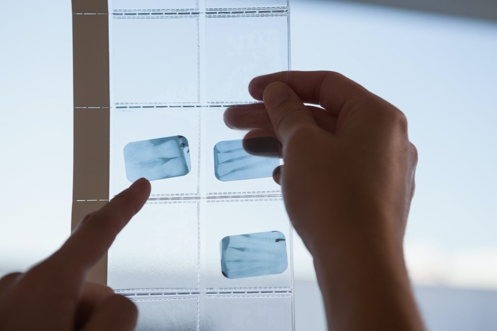 Radiografías Dentales 22 Dental X-Ray in Oxnard