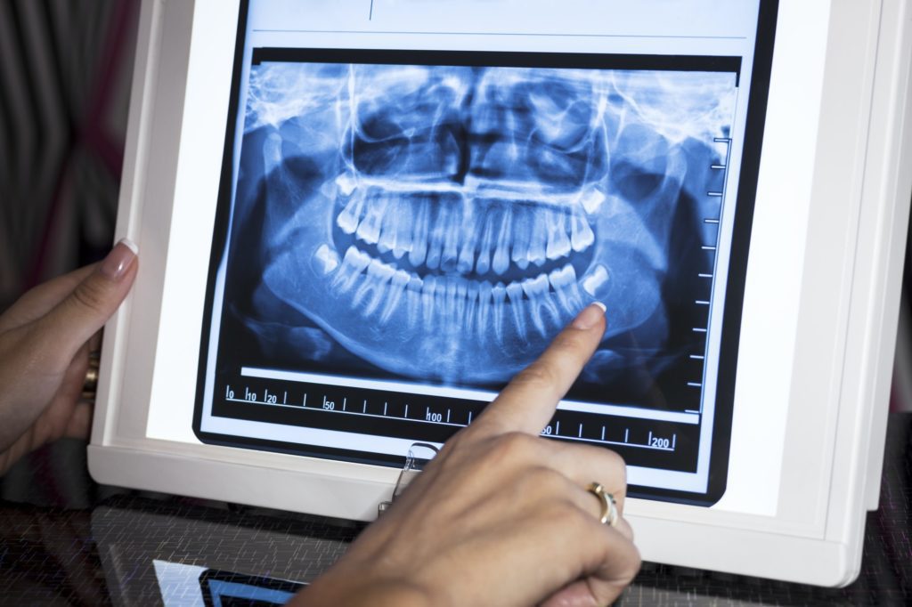 Dental X-Rays 22 Dental X-Rays - Radiografías Dentales