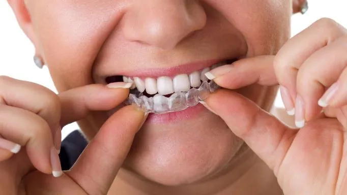 Nightguards 16 woman putting invisalign aligners on her teeth