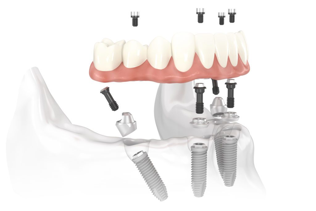 All On 4 Dental Implants 8 Nobel Biocare All on 4 solution