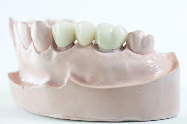 PUENTE DENTAL 1 PUENTE DENTAL