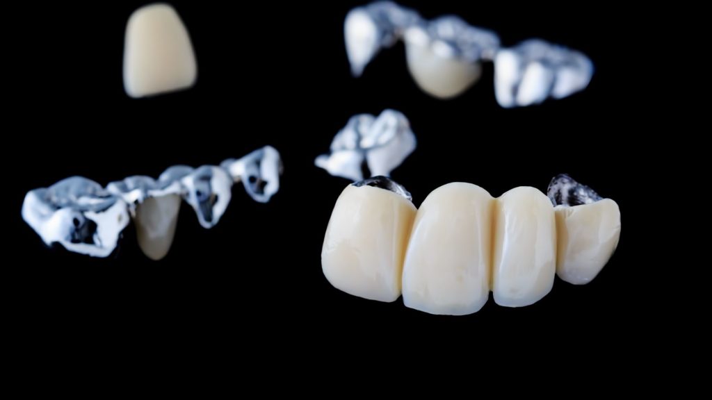 Dental Bridge 3 dental bridge