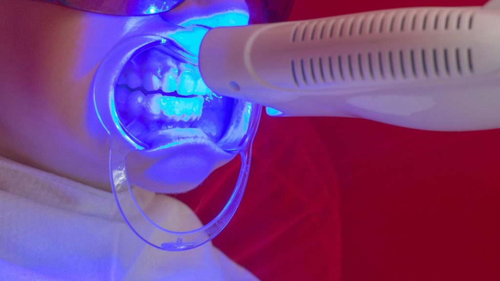 Laser teeth whitening with zoom 6 laser teeth whitening with zoom