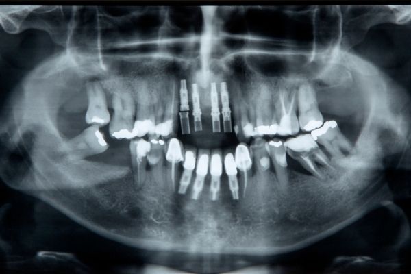 Intra Oral Dental Imaging