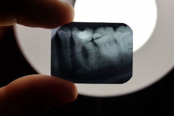 Intra Oral Dental Imaging
