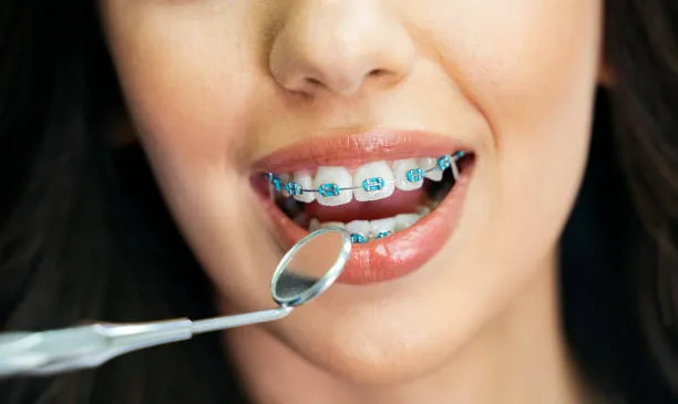 Mothers Day Dental Special 14 Dental braces