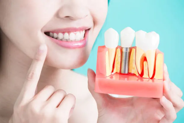 Implantes Dentales 23 dental implants