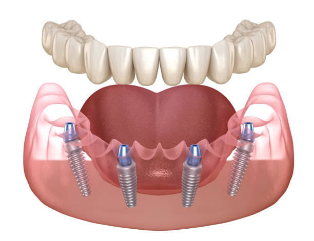 Dental implant animation