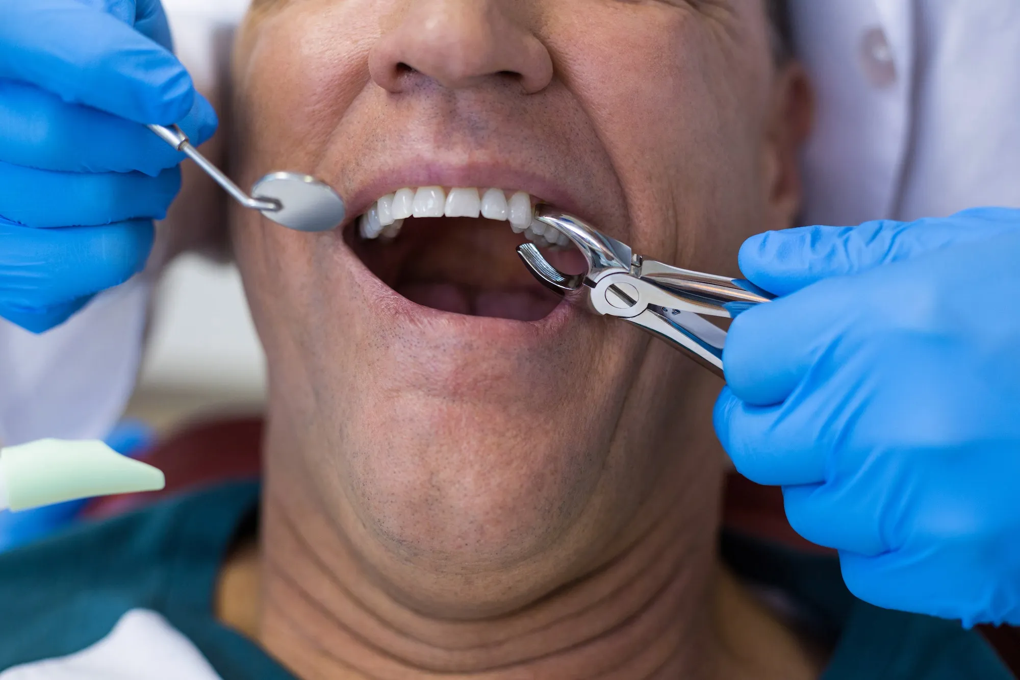 dentist using surgical pliers to remove a decaying tooth 4 11zon