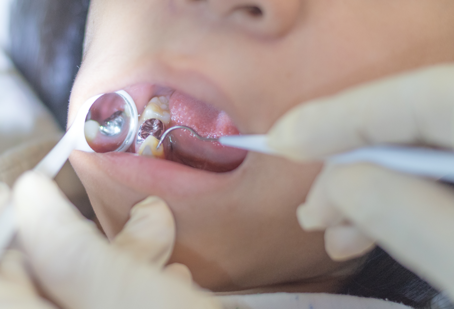 Dentista Pediátrico 6 amalgam filling