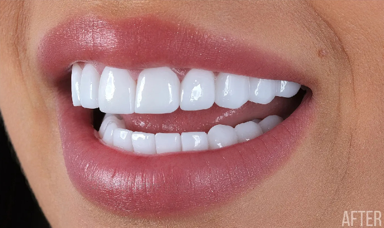 crowns after Dental Crowns In Oxnard