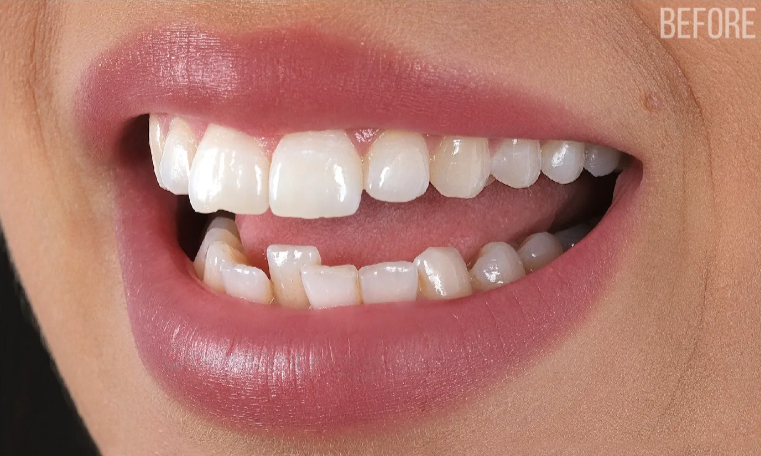 crowns befora Dental Crowns In Oxnard