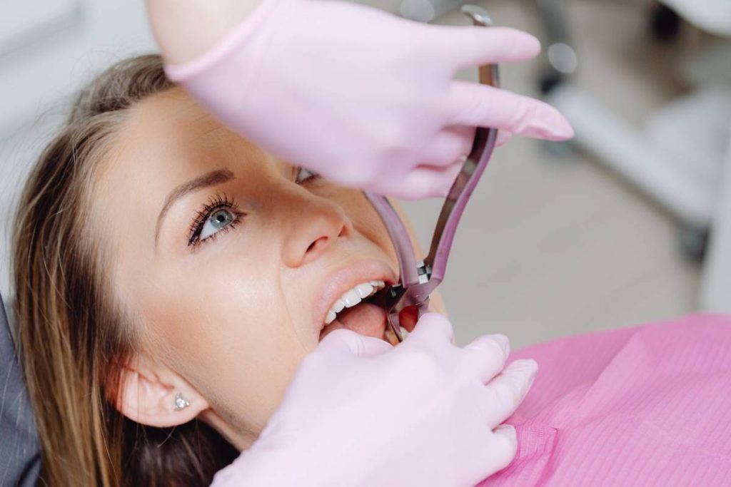 Dentist that accepts Gold Coast Dental Insurance 19 Dental extractions
