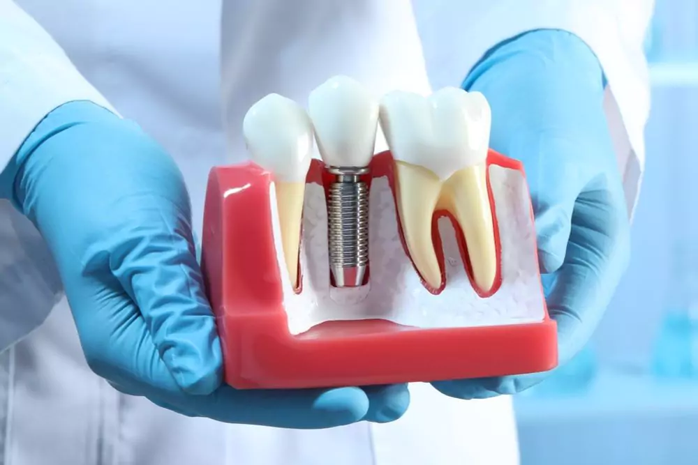 Implantes Dentales para Personas Mayores 22 Dental Implant Model