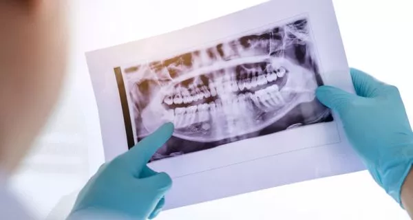 What are wisdom teeth?
